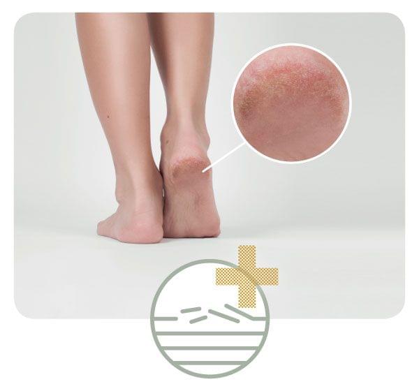 Crema calcaie crapate, piele crapata, aspra - crema cu miere de Manuka (50ml) 3 Crema calcaie crapate, piele crapata, aspra - crema cu miere de Manuka (50ml) - imagine 3